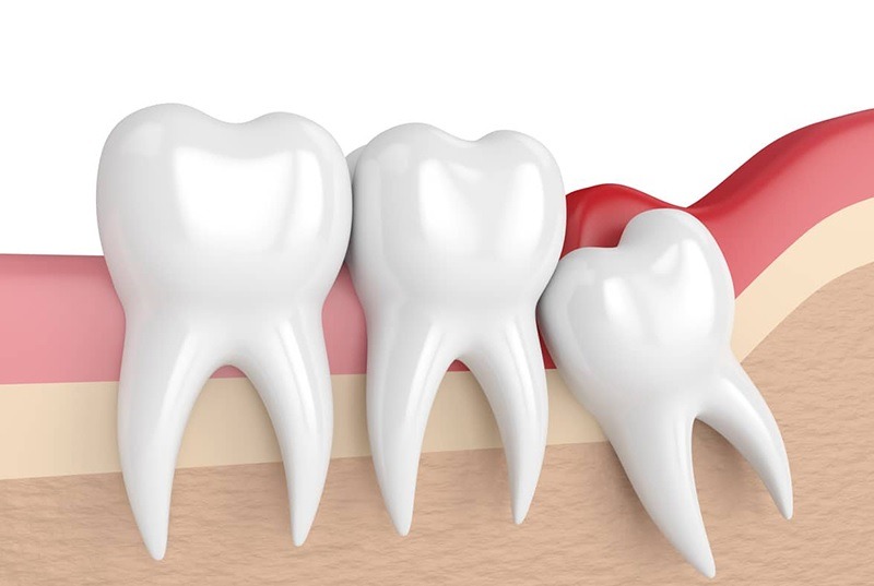 Răng khôn mọc lệch thường gặp hiện nay