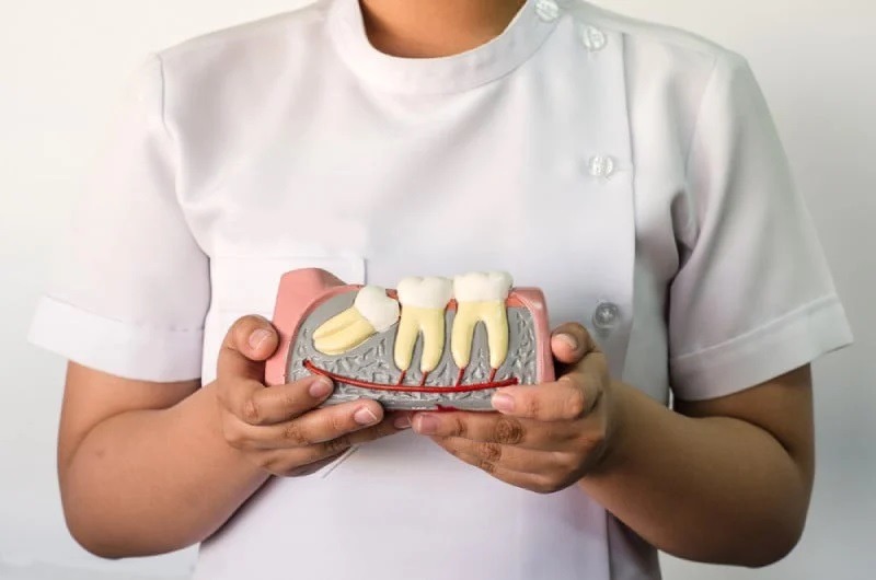 Răng khôn mọc lệch có thể gây ra nhiều biến chứng