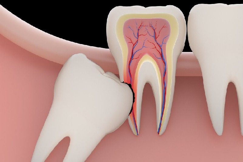 Răng mọc lệch ảnh hưởng đến vị trí của các răng khác