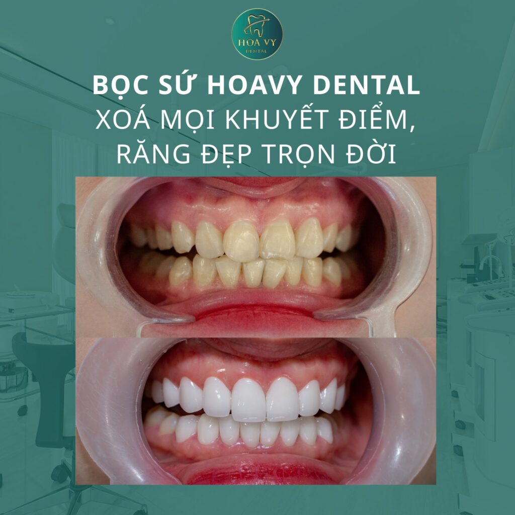 18 RĂNG SỨ HT SMILE tại HoaVy Dental - chỉ sau 2 ngày, chị khách hàng đã sở hữu nụ cười hoàn hảo như mong muốn