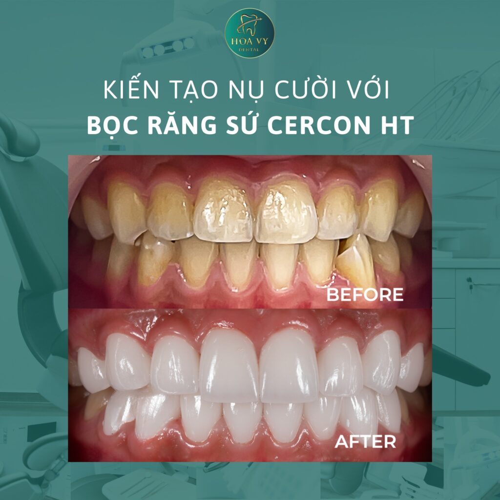 Bọc răng sứ Cercon HT – công nghệ phục hình hiện đại tại Nha khoa Quốc tế HoaVy Dental.