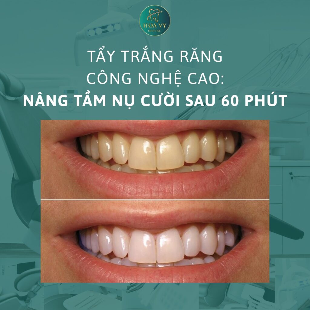 Chỉ 1 buổi tẩy trắng tại HoaVy Dental, hàm răng sẽ bật tone trắng sáng, tự tin khoe nụ cười ngay lập tức.