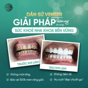 Khi nào nên dán sứ Veneer? Cùng Nha khoa Quốc tế HoaVy Dental giải đáp câu hỏi.