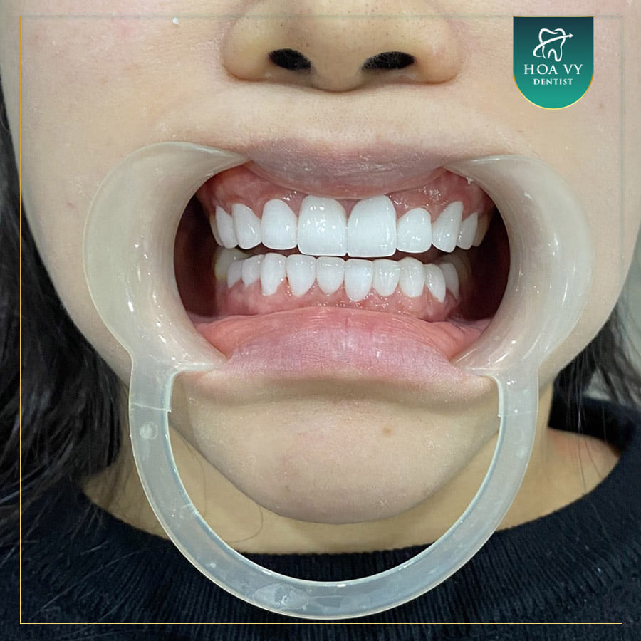 Hình ảnh sau khi khách hàng dán sứ Veneer tại Nha khoa quốc tế HoaVy Dental