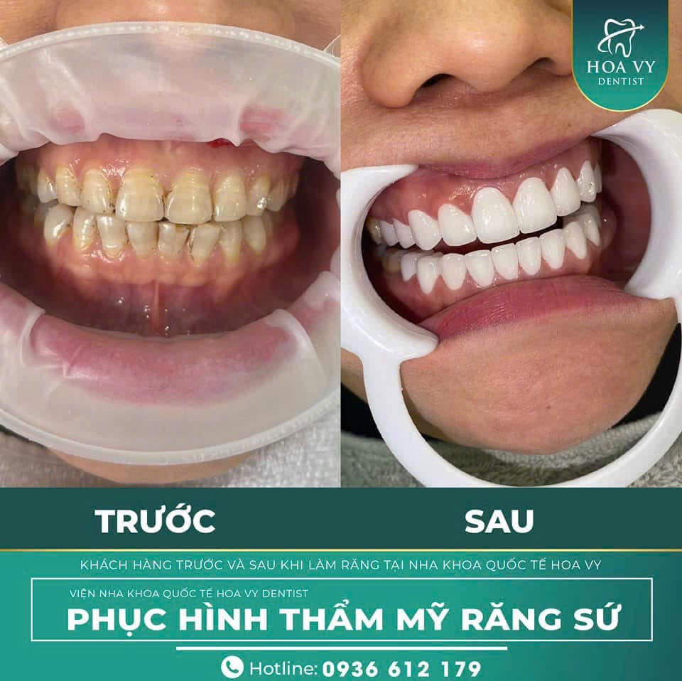 Kết quả trước và sau khi quá trình phục hình răng sứ tại Nha khoa quốc tế HoaVy Dental