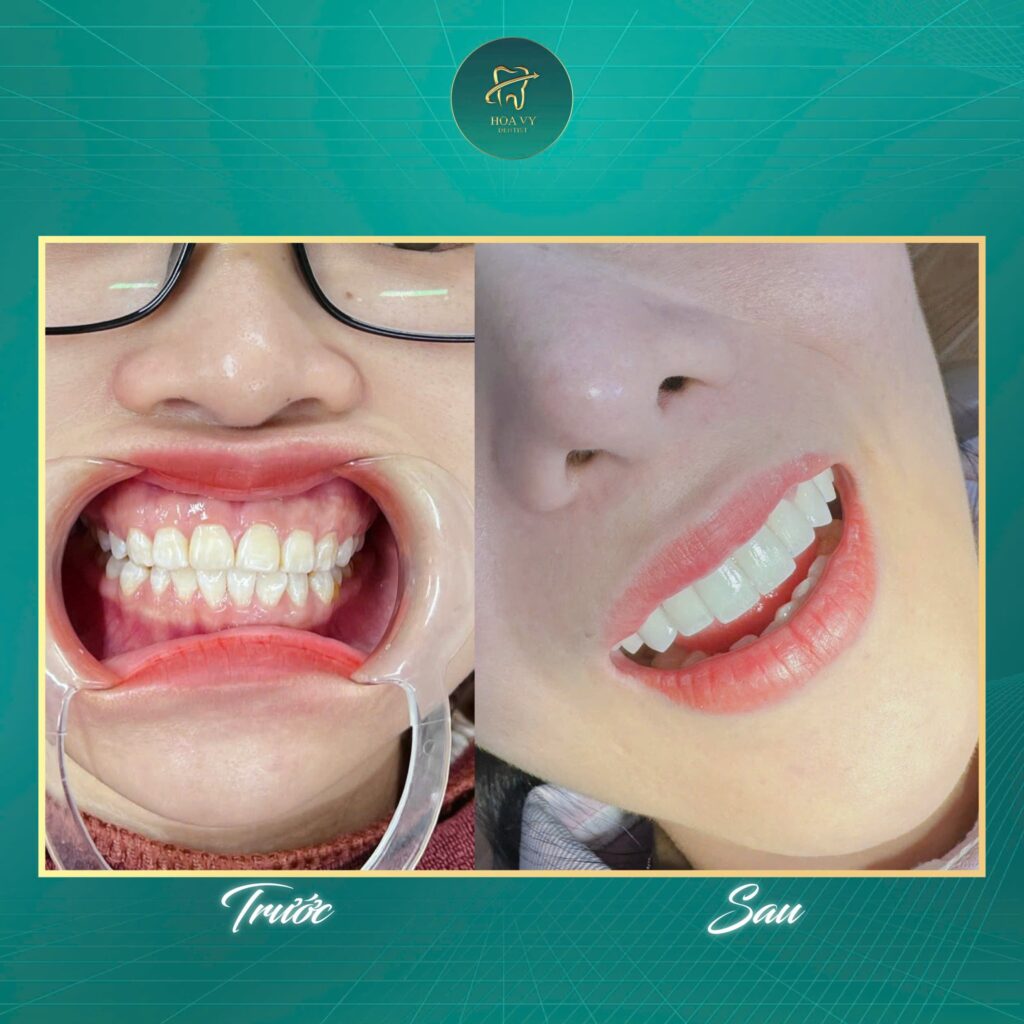 Kết quả dán sứ Veneer giúp nụ cười trắng sáng, hài hòa và tự nhiên.