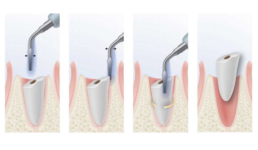 Phương pháp nhổ răng Piezotome hiện đại giúp quá trình nhổ răng khôn an toàn và nhẹ nhàng hơn