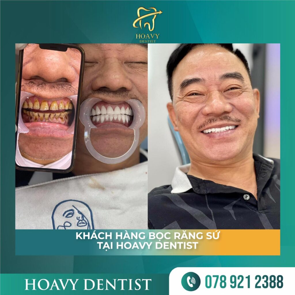 Bọc răng sứ giúp bảo vệ răng thật: Lớp sứ có độ chịu lực cao, ăn nhai như răng thật, bao bọc bên ngoài giúp ngăn răng gốc bị tổn thương, sâu hoặc mòn men.