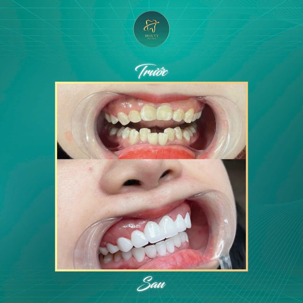 Kỹ thuật Veneer là một trong những giải pháp được khuyến khích cho các trường hợp phục hình răng nhẹ, vì giúp duy trì mô răng thật tối đa, giảm nguy cơ ê buốt và đảm bảo độ tự nhiên cao.