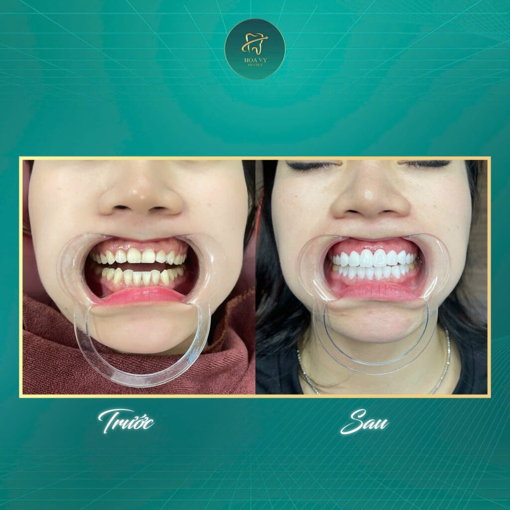 Dán sứ Veneer sẽ giúp răng trở nên hài hòa, cân đối với khuôn mặt mà vẫn đảm bảo chức năng nhai.