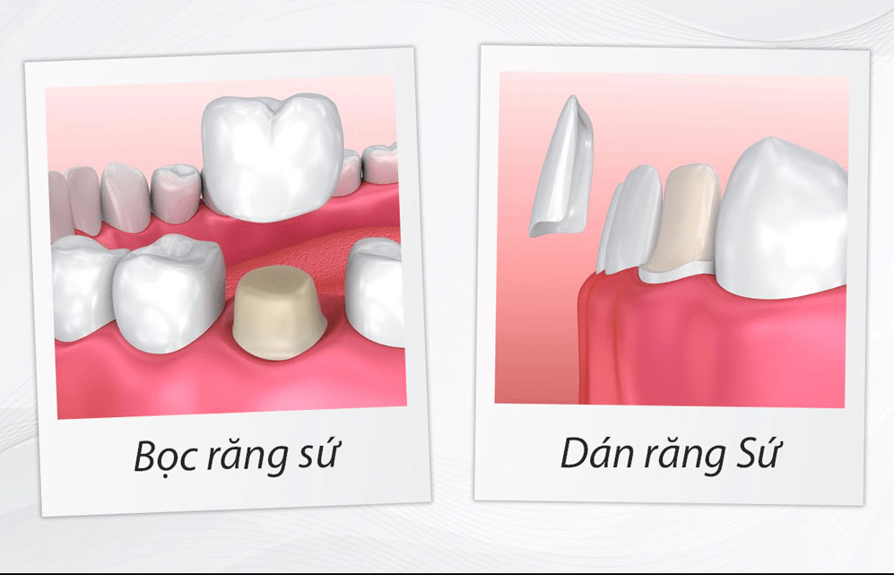 Minh họa cấu trúc Veneer và mão sứ.